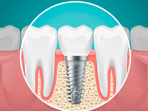 implantes